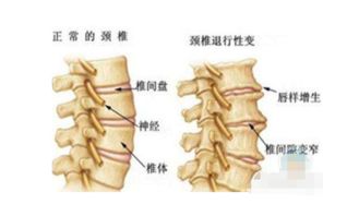 骨科专家总结,治疗颈椎骨质增生的7种有效方法 