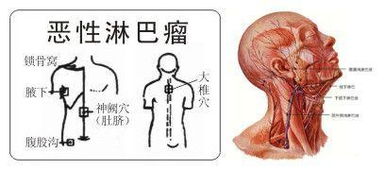 淋巴癌手术后发现骨转移怎么办 