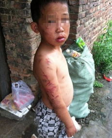 福建9岁男孩遭母亲长期虐待 被剪刀剪耳朵划脸
