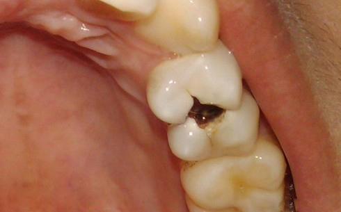 你的 虫牙 真的是虫子造成的吗 
