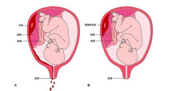 孕妇突发胎盘早剥,紧急手术后休克和心衰