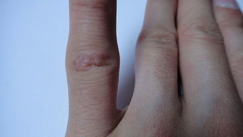 手指关节疤痕 
