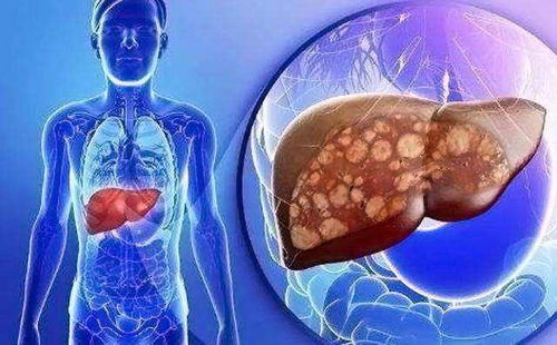 重度脂肪肝的治疗方法 重度脂肪肝对人体的危害有哪些？该如何治疗？ 