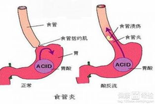 食管炎吃什么药好