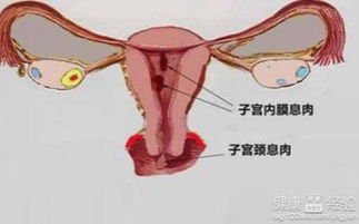 宫颈息肉对女性有什么影响