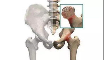 20来岁股骨头坏死，有轻微塌陷，换什么材料的股骨头结实啊？