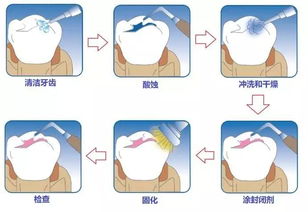 窝沟封闭与涂氟是怎么保护牙齿的