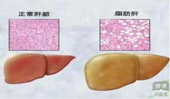 不同时期脂肪肝症状有哪些 脂肪肝是如何发生的