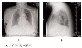 病例解析 术前评估决策老年患者麻醉方法1例