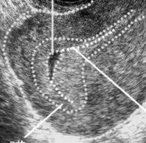 试管婴儿早孕囊 假孕囊与空孕囊怎样鉴别