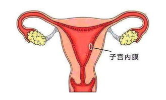 预防子宫内膜炎关注哪些方面，可以试管移植吗？