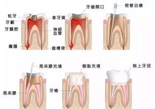 根管治疗后,牙齿还能用多久