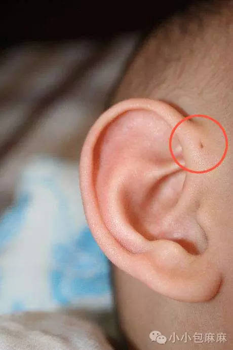 这个小洞一半孩子的耳朵上都有,千万别乱碰 