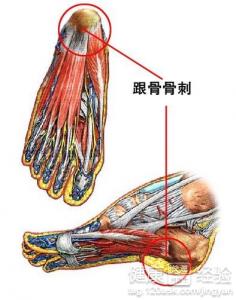 脚踝骨刺的症状图片 搜狗图片搜索