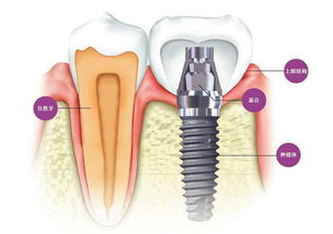 种植牙一颗多少钱 