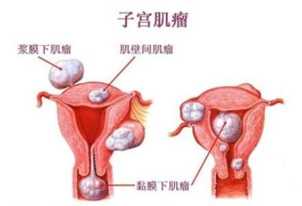 子宫肌瘤不要小觑，这些危害要知道！