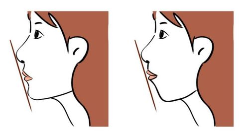 丰下巴还能改善嘴凸 隆下巴方法很多,哪种适合你