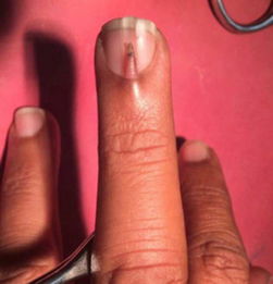 罕见 巴基斯坦男子指甲盖上长出小指甲 全球仅4例 