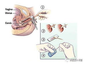 如何进行宫颈癌筛查,LCT和HPV有什么区别 