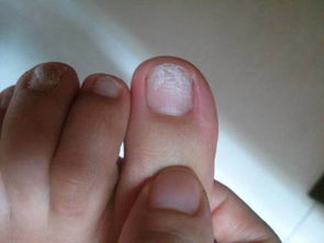 脚趾甲做了光疗甲美甲,现在把指甲油扣掉了,指甲变成了这样 还能恢复吗 