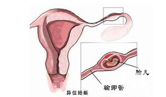 宫外孕有什么症状前期，宫外孕有什么症状