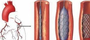 为什么冠状动脉狭窄了必须安装支架，而不是以手术方式来剥离血管内壁的脂肪呢