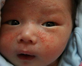 宝宝脸上长湿疹怎么办(婴儿宝宝脸上长湿疹怎么办)