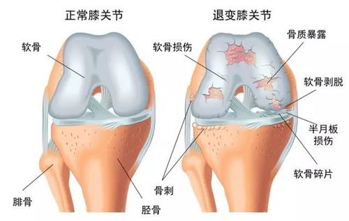 郎指导做了一个什么手术 保护关节 合理运动真的重要