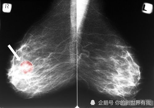 教你1分钟自检 三种结节一定要及时切除,一拖再拖或会癌变