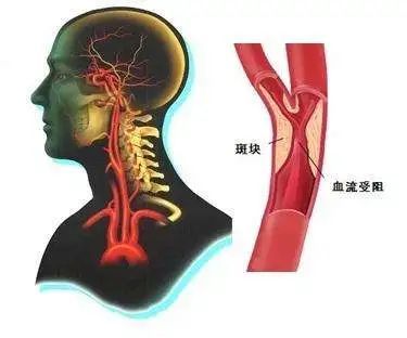 血管造影正在与心脏支架一样被滥用,请学点知识保护自己的健康