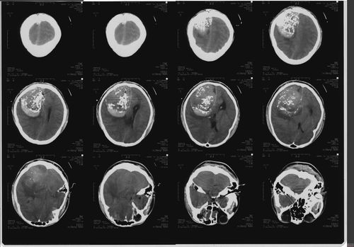 每日一例 典型病案 CT