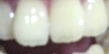 我的两颗门牙有个三角形的缝隙整牙能去除吗 