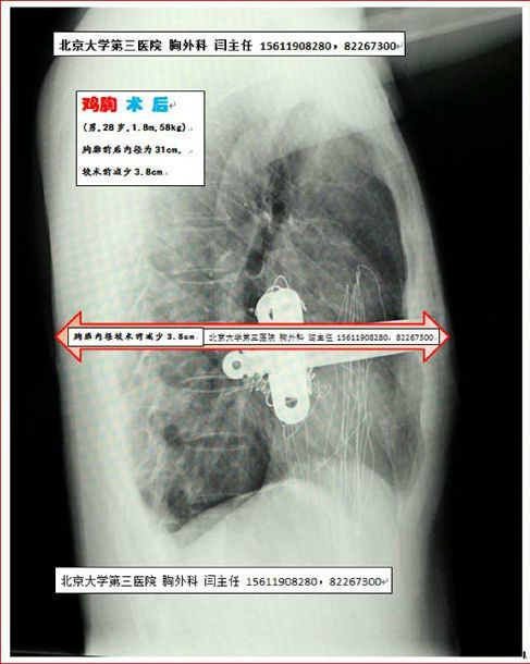 鸡胸治疗鸡胸不可怕,一定治好它 有图