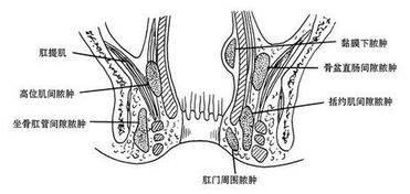 长沙肛周脓肿怎么治疗好 