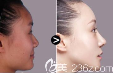 鼻头肥大与鼻梁歪斜如何改善 全肋骨和半肋隆鼻在效果上有何区别