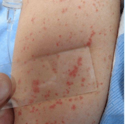 四道科普 孩子身上出红疹,要重视 稍不注意就会耽误过敏性紫癜的最佳治疗时期