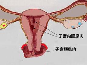 息肉 什么是息肉