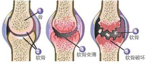 软骨素对关节疼痛的缓解真的有效吗 各种实验结果如何