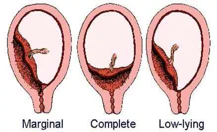 中央性前置胎盘