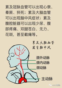 这种疾病十有八九会要命,如何预防非常重要 