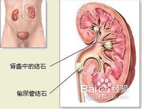 济南泌尿碎石医院哪家好 济南治疗肾结石的费用明细 