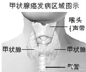 甲状腺癌转移气管寿命(应该怎样去分辨甲状腺癌的初期)