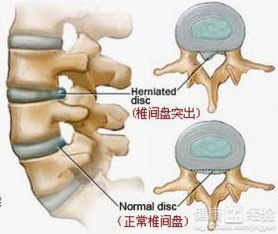 怎样预防腰椎间盘突出