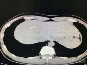右肝钙化灶 斗图表情包大全 - 与 右肝钙化灶 相