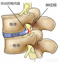 腰椎间盘突出发炎后会引起下肢不适,怎么才能去除这些不适症状 