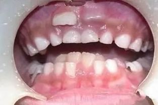 小孩子的双排牙可以预防吗