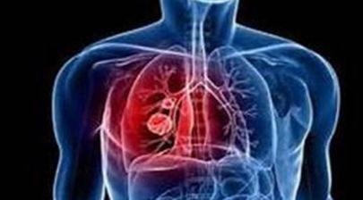 哪些人更容易患肺癌呢 早期肺癌通过哪些检查才能被发现呢
