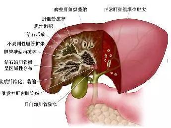 胆囊长了息肉会有哪些症状 哪些人需要特别注意