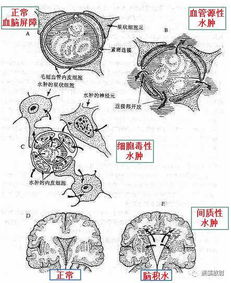 和 水 相关的几个概念 自由水和结合水 脑水肿 你清楚吗 