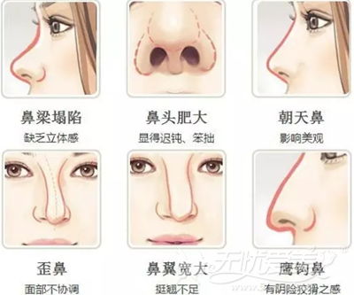 去韩国做隆鼻整形术 打造独一无二自然小翘鼻